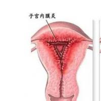 警惕！好孕的隐形刽子手——慢性子宫内膜炎（上）