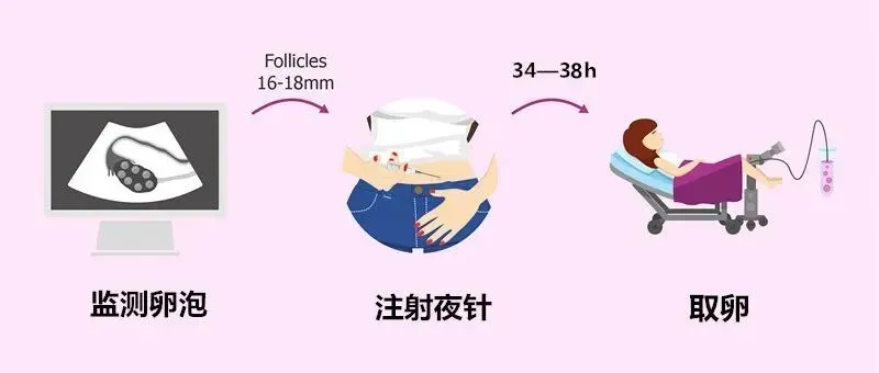 沉浸式体验取卵流程，这几件事你一定要重视！